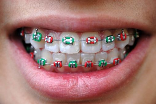 Image of holiday colored braces