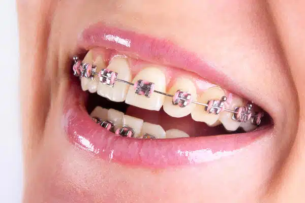 oral-care-braces