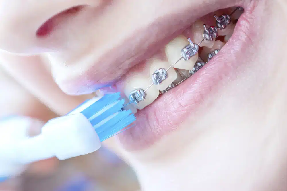 Ways to Improve Oral Health in Braces