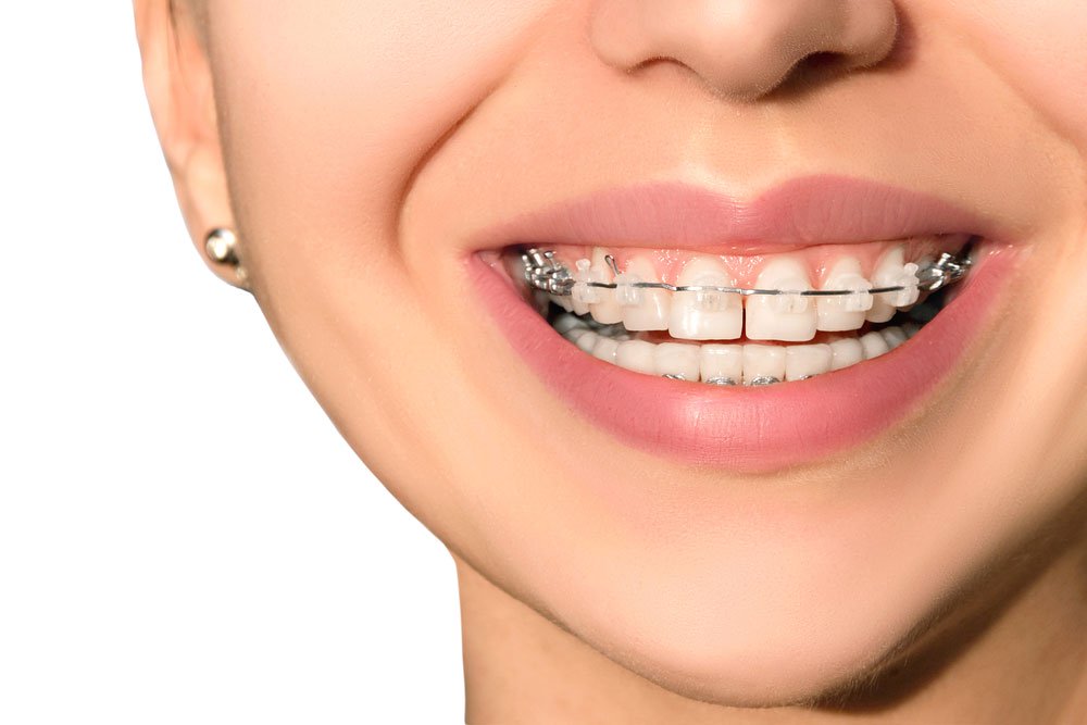 adult-braces