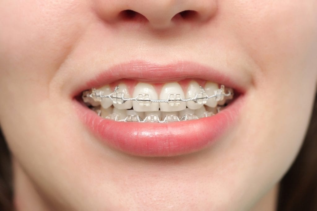 first-days-in-braces