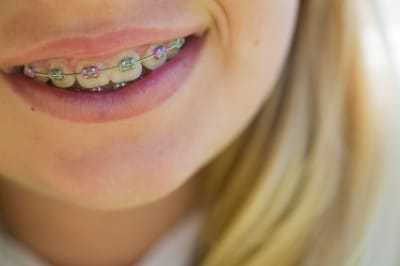 Which Braces Type Is Right for You?