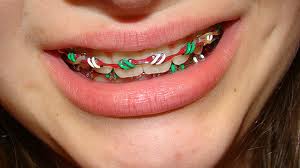 A Guide To Holiday Snacking For Braces-Wearers