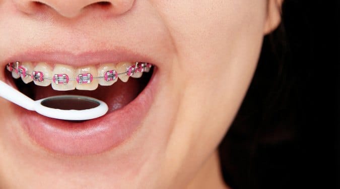 Oral Hygiene &amp; Braces: What You Need to Know
