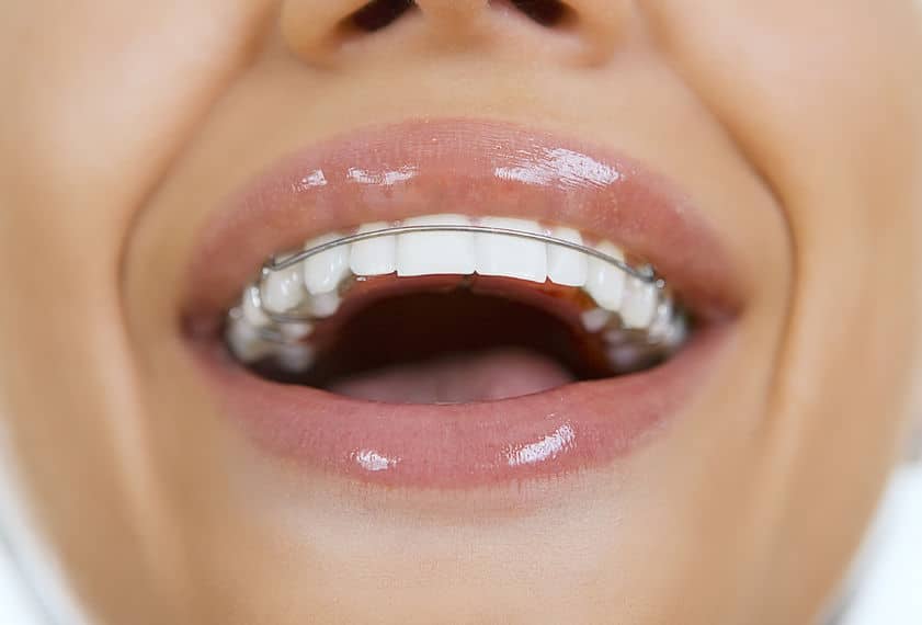 3 Retainers that May Be the Perfect Fit for Your Smile!