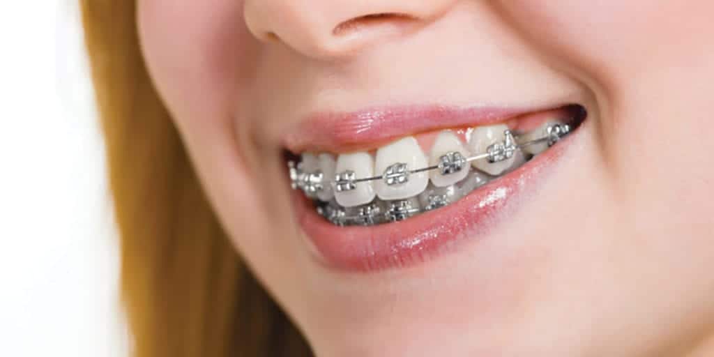 How do orthodontists bond braces to teeth? « Smiles by White