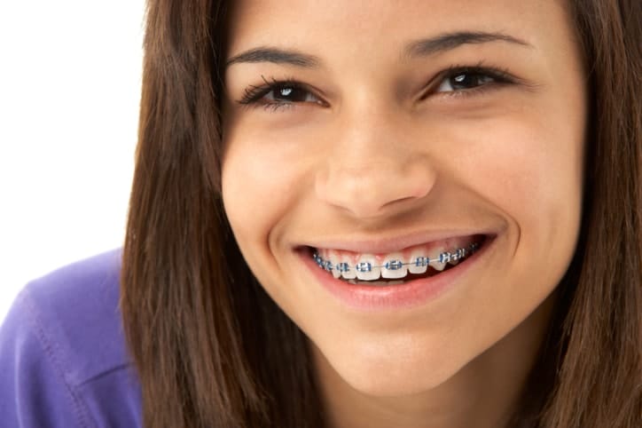 How to Prepare for Getting Braces Placed
