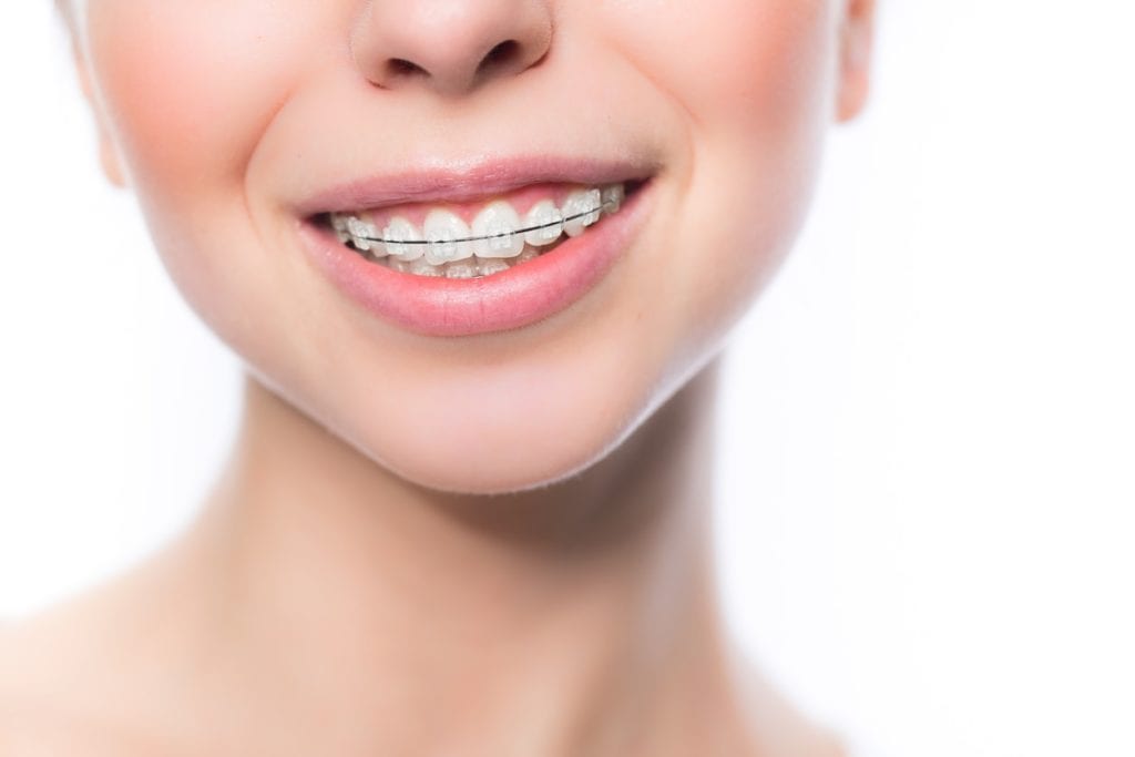 ceramic-braces-min