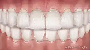 image of teeth with clear aligners