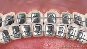 lingual-braces image of lingual braces