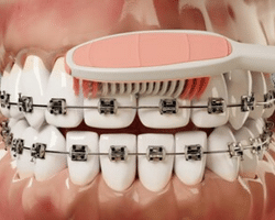 Braces and brushing