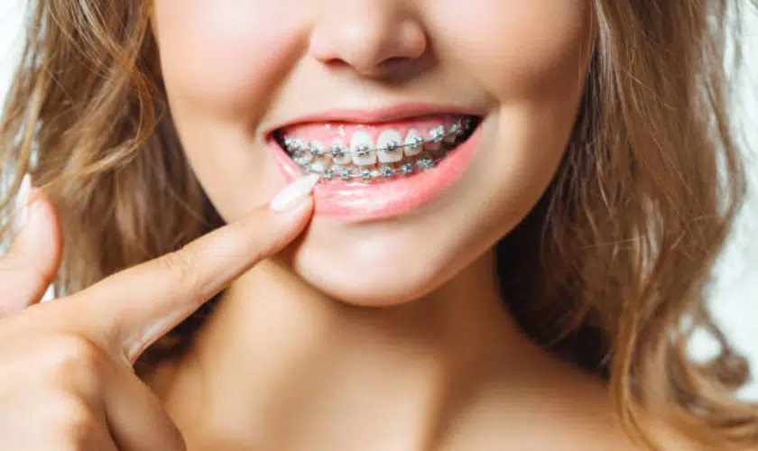 Braces