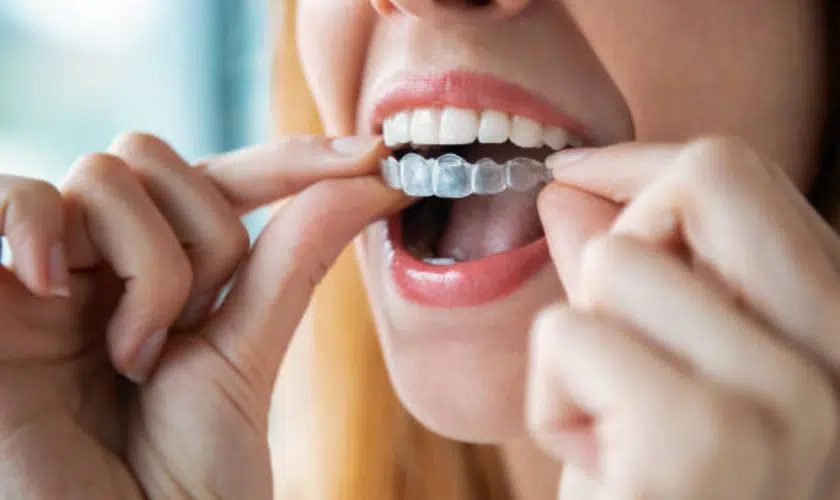 Invisalign Alexandria