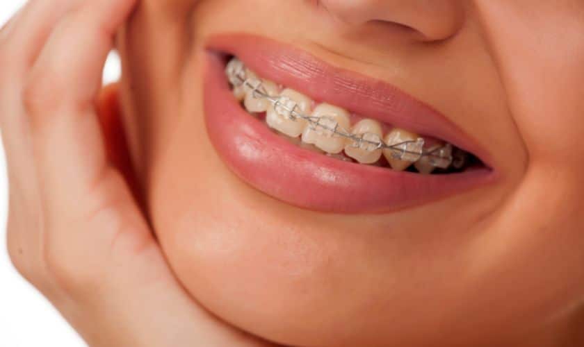 Adult Braces in Alexandria - Perfect Smiles Orthodontics