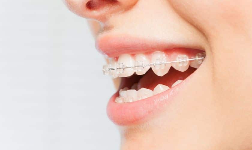 braces in alexandria - Perfect Smiles Orthodontics