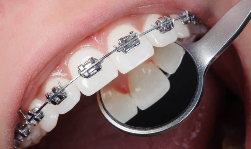 braces alexandria va - Perfect Smiles Orthodontics
