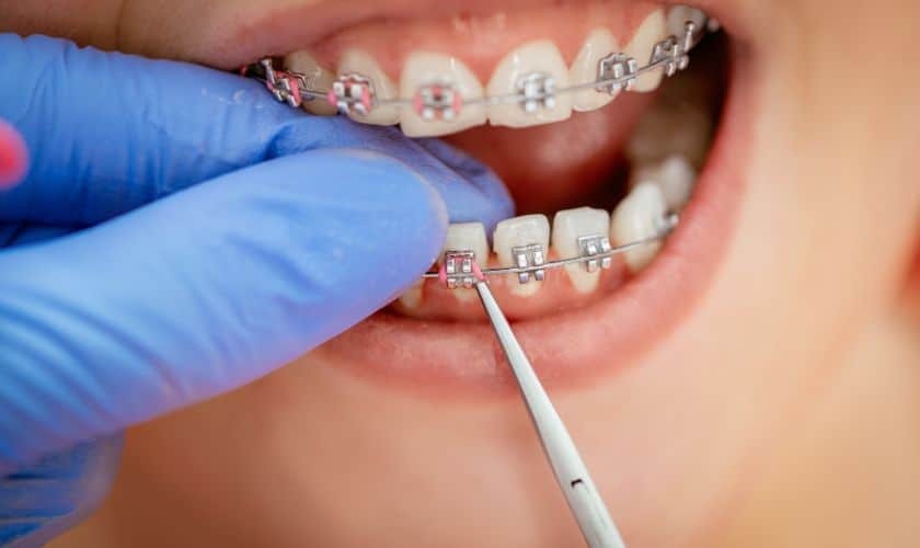 3 Benefits of Clear Braces - Alexandria Old Town Dental Alexandria Virginia