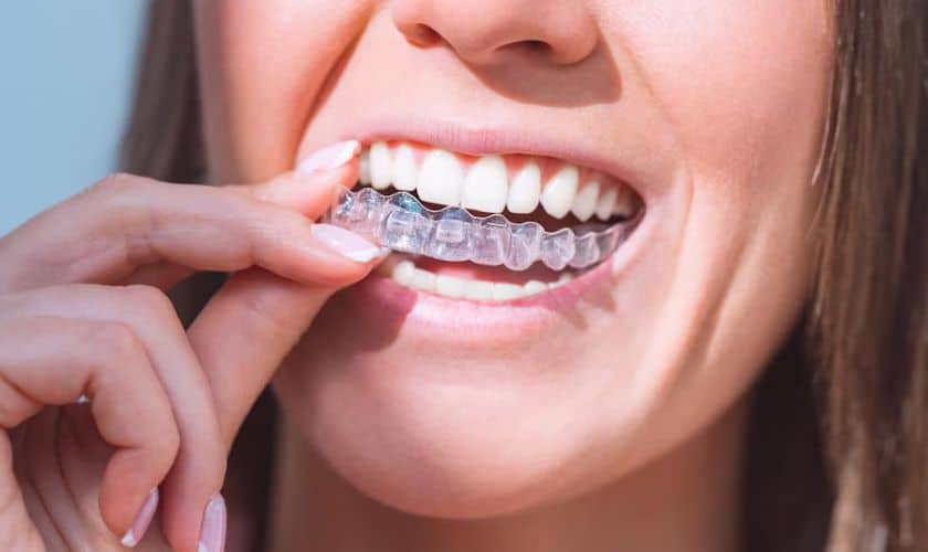 invisalign alexandria