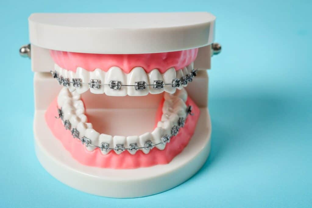 Adult Braces Alexandria
