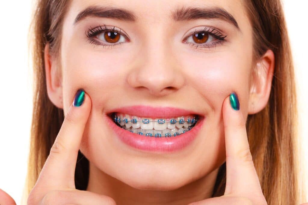 Braces in Alexandria
