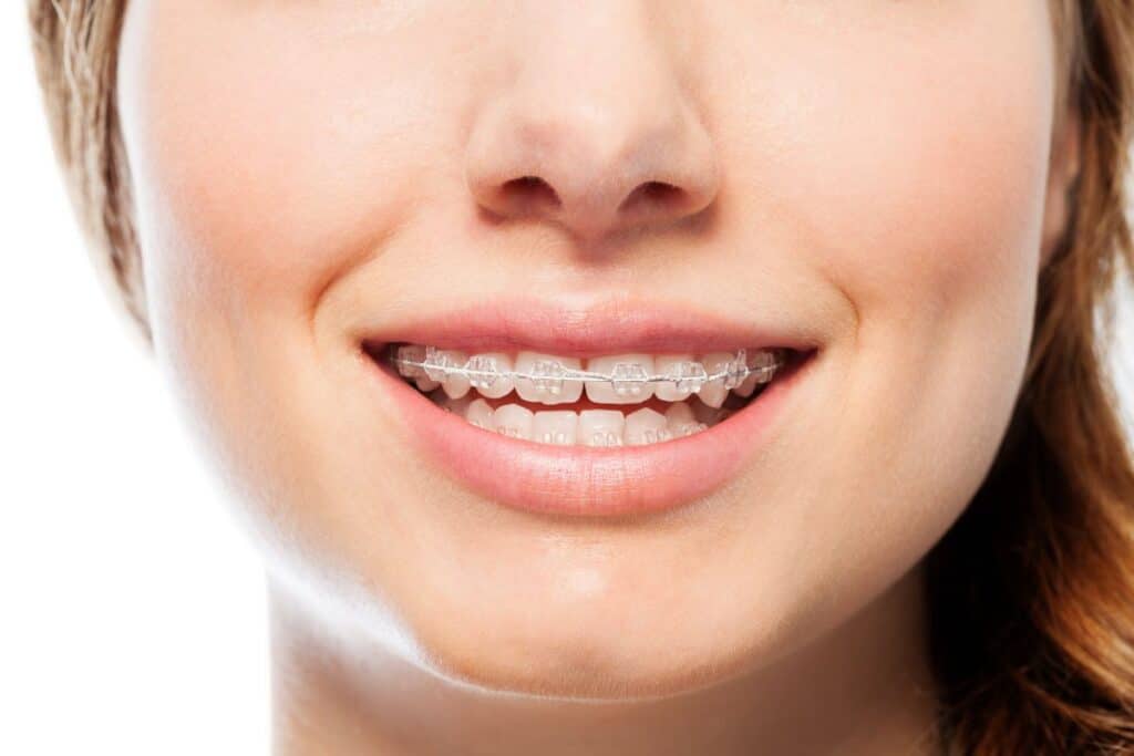 Clear Braces Clear Braces
