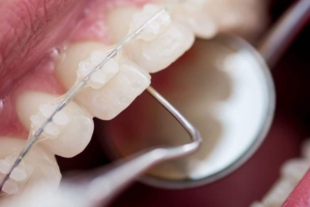Clear Braces Alexandria Clear Braces Alexandria