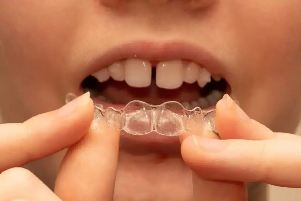 Gaps Between Teeth Gaps Between Teeth