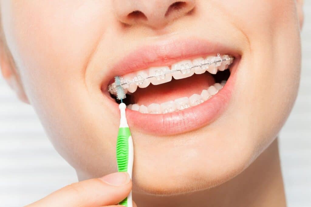Braces For Adults Braces For Adults