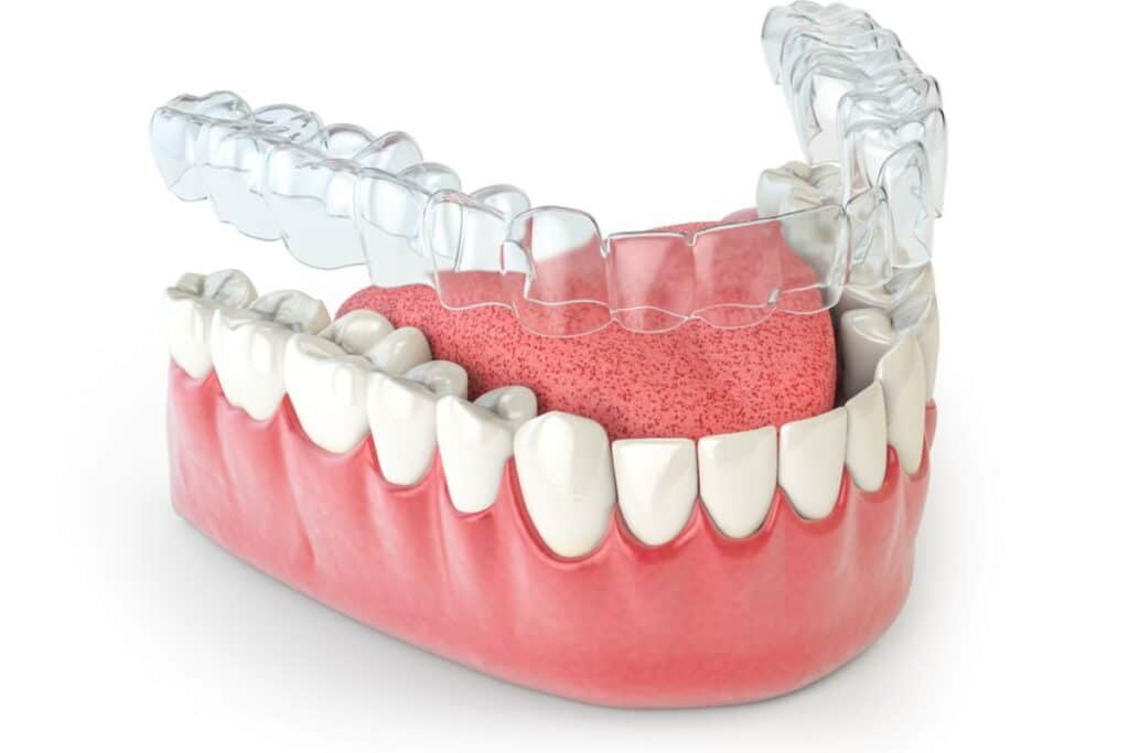 Invisalign Alexandria Invisalign Alexandria