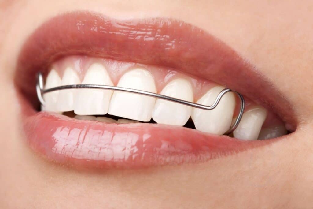 Is Orthodontic Treatment Necessary Is Orthodontic Treatment Necessary