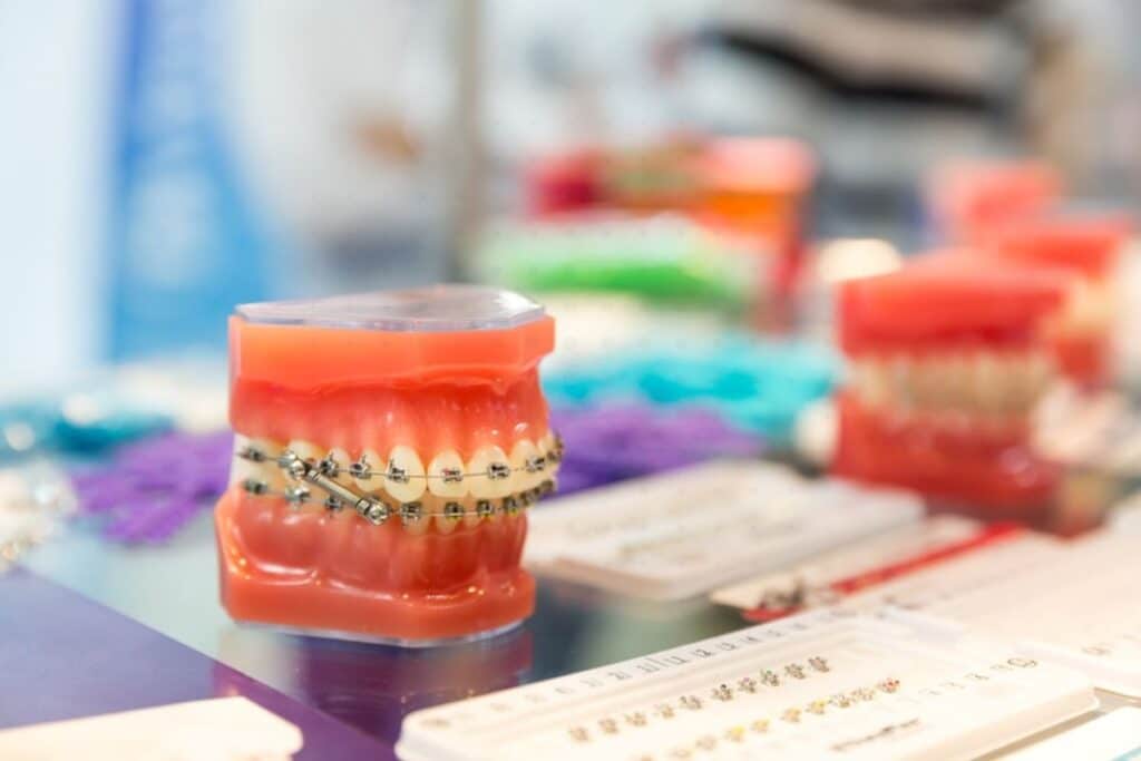 Can Orthodontic Treatment Cause Gum Recession Can Orthodontic Treatment Cause Gum Recession