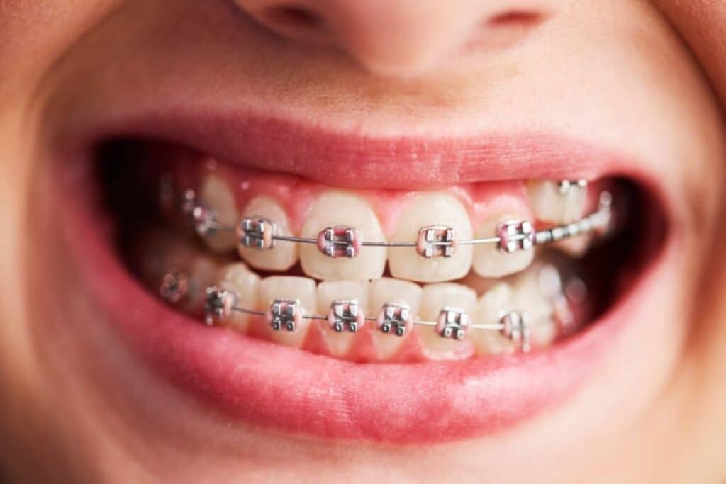 Can You Chew Gum with Braces Can You Chew Gum with Braces