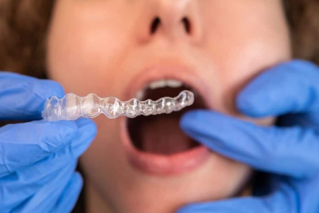 Is Invisalign Worth It Is Invisalign Worth It