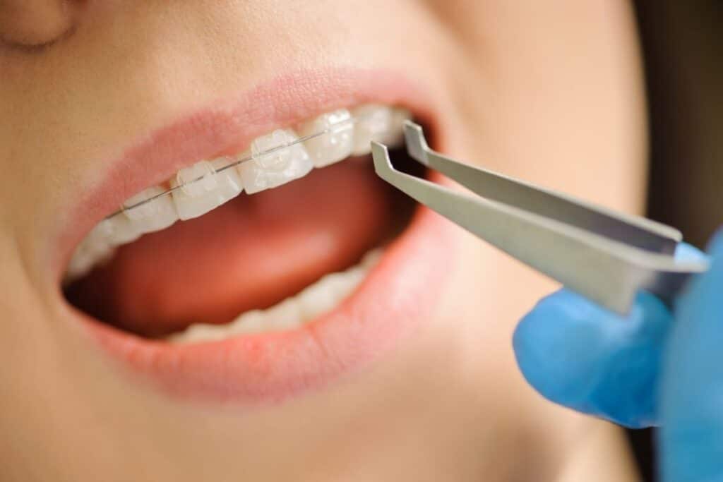 Are Ceramic Braces Worth It Are Ceramic Braces Worth It