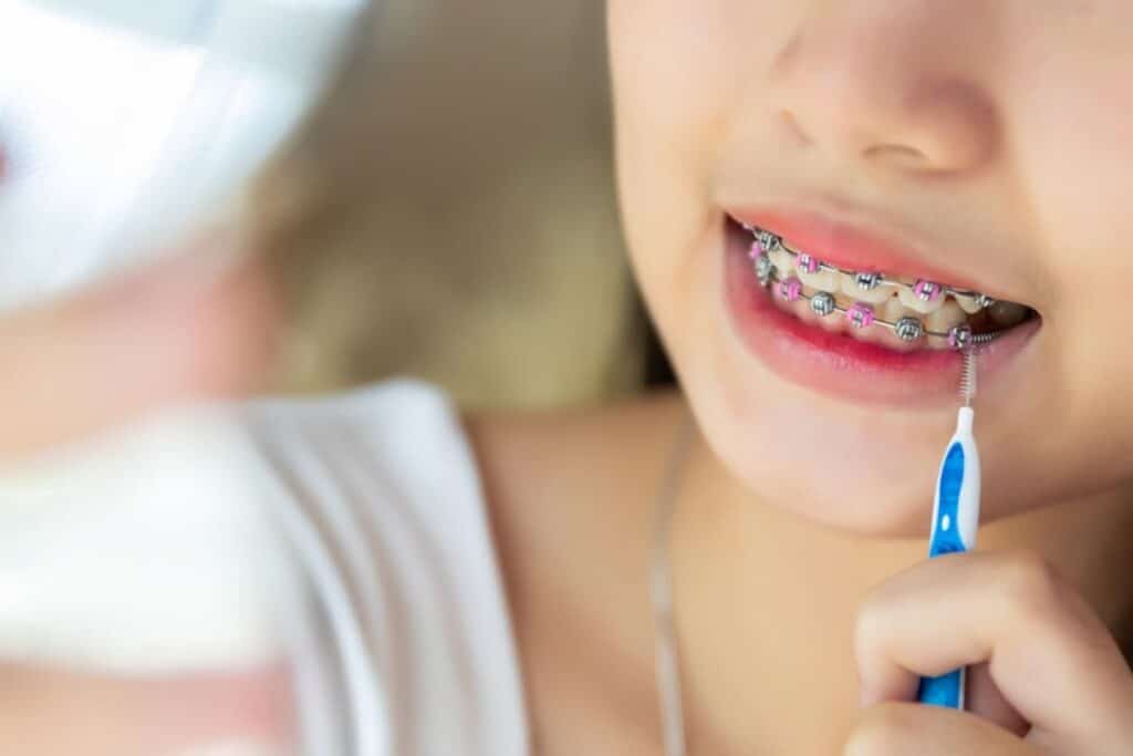 How Do Metal Braces Work How Do Metal Braces Work