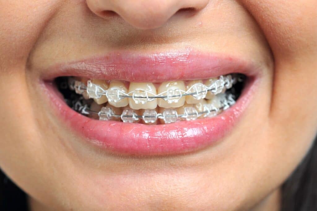 How to Keep Ceramic Braces White How to Keep Ceramic Braces White