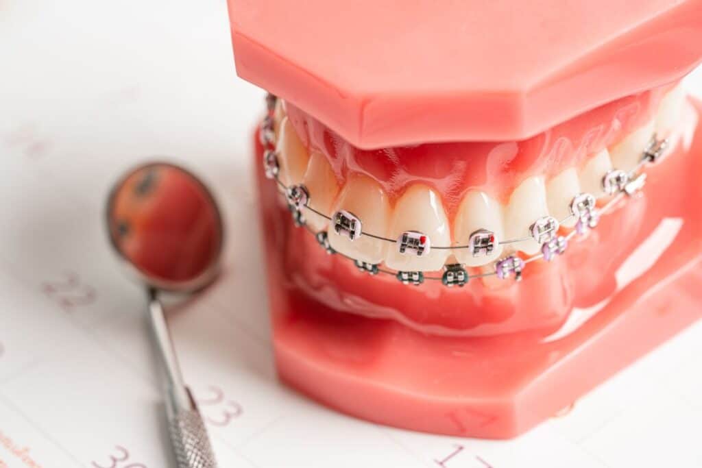 can you eat popcorn with braces​