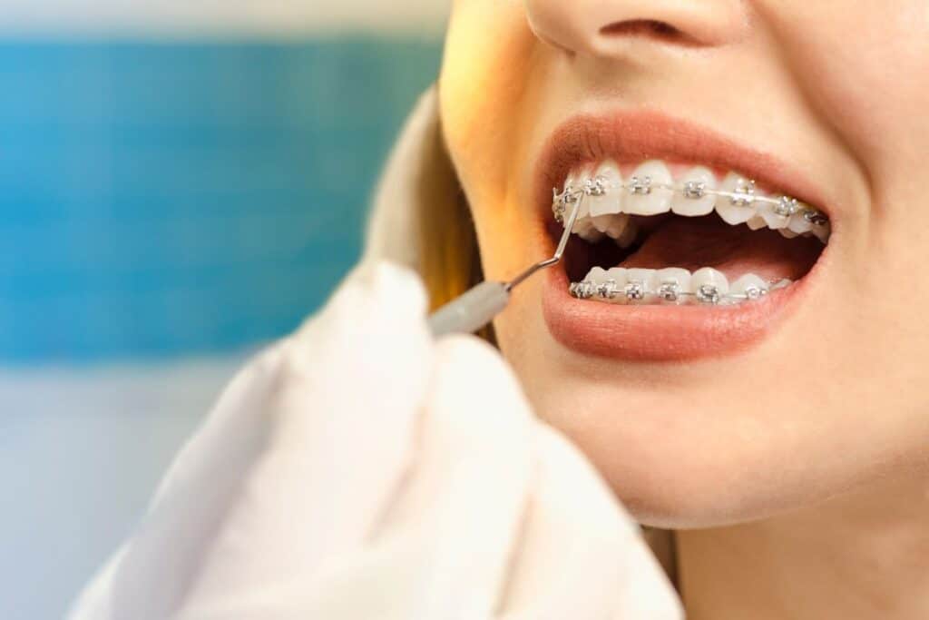 Tips for Easing Discomfort After Getting Braces Tightened Tips for Easing Discomfort After Getting Braces Tightened