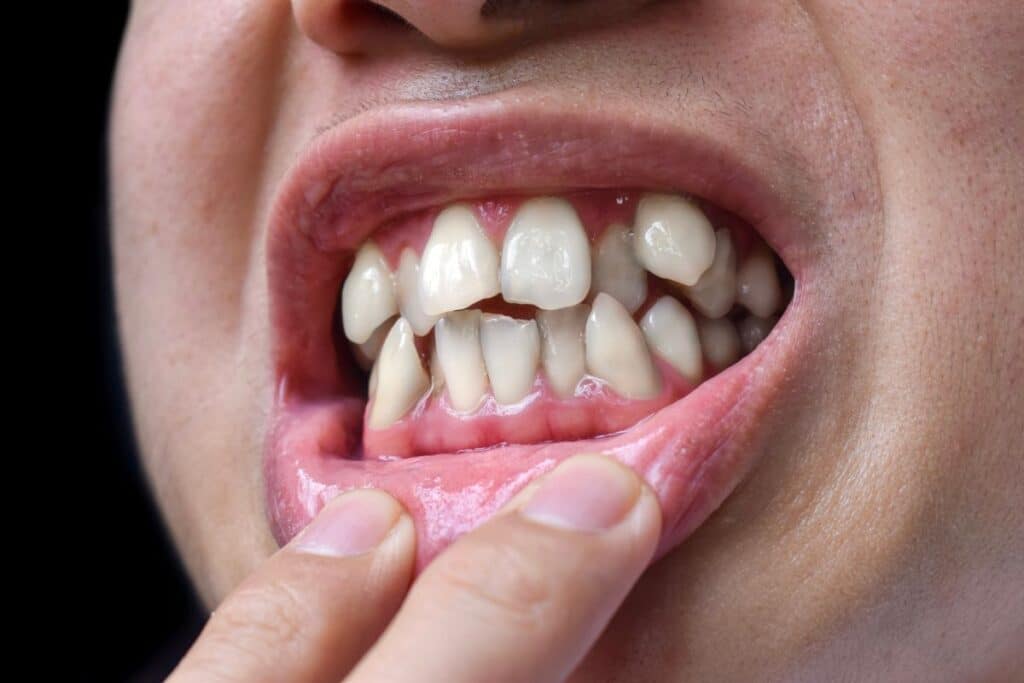 teeth-crowding-treatment-alexandria teeth-crowding-treatment-alexandria