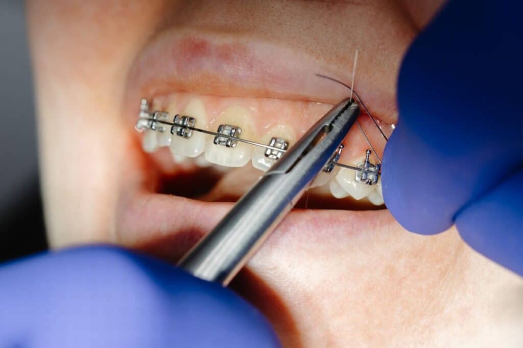 Speed Up Your Braces Treatment